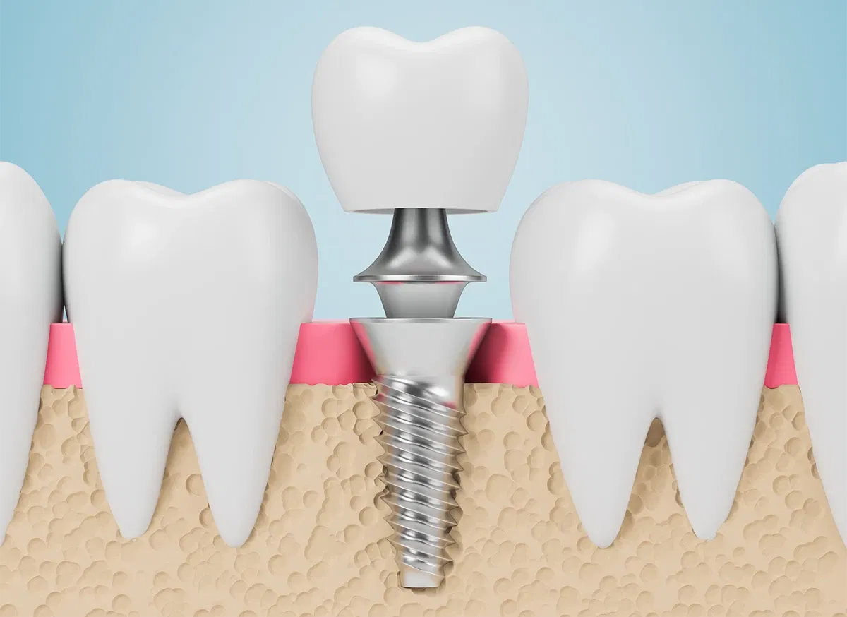 3D illustration of a dental implant in the jawbone 3D illustration of a dental implant in the jawbone
